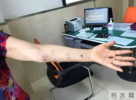 带状疱疹都是咋来的医生调查发现-患带状疱疹的人，有这8大共性