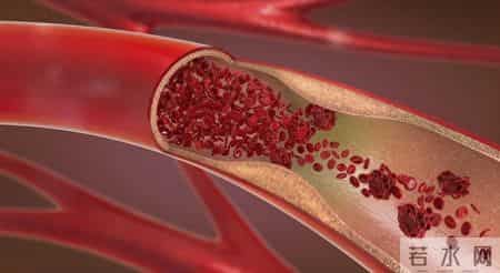 血栓"大户"被揪出，是肥肉的13倍！医生：经常吃，血管或扛不住
