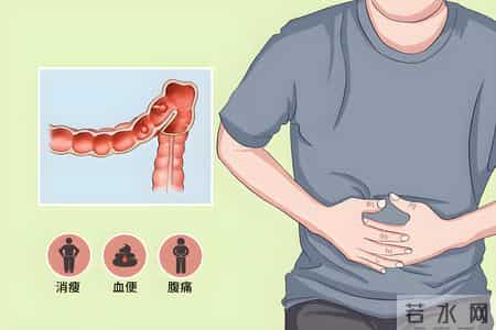 原来结肠癌晚期可这么治！可惜很多人不知道