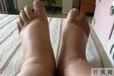 一周就肾衰竭！医生苦劝：糖尿病人若出现这3种不适，立刻去医院