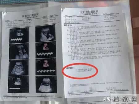 辽宁孕妈产检一胎变四胎！罕见同卵四胞胎伴无心畸胎引全网揪心！