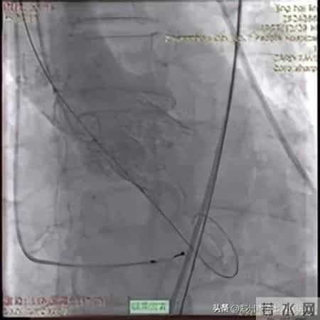 全国首批！心脏瓣膜置换开启新时代