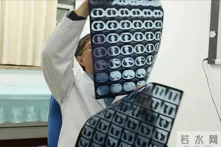 多名医生再三强调：一旦做过胸部CT，患者一定要多加关注这5点！