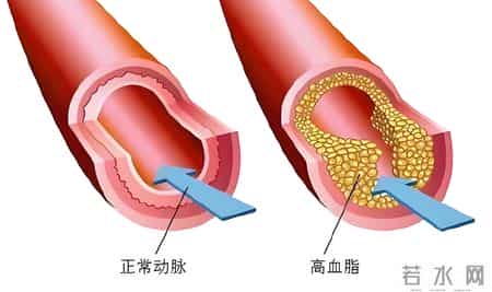 59岁女子因糖尿病离世，医生苦劝：天冷时吃二甲双胍，多注意5点