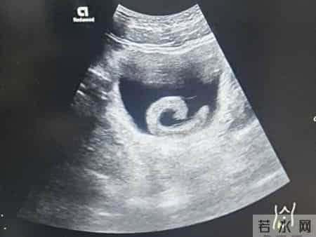 23岁男子信偏方把5cm水蛭塞进尿道，致剧烈疼痛、排尿困难，医生提醒