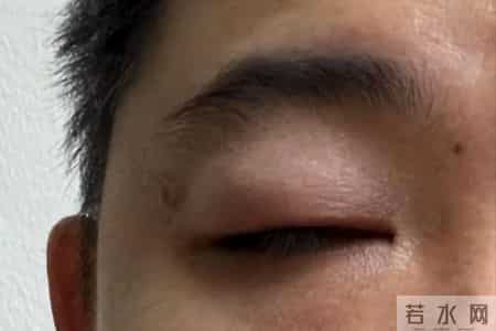 医生提醒：肾衰竭早期不是腰痛，而是身体出现5种异常，一定留意