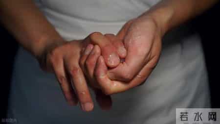 糖尿病人双手3个表现，代表你身体出现3大问题，每1个都不是小事