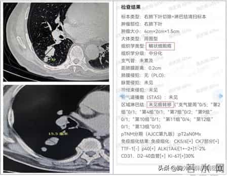 都是2cm肺结节，为何一个轻松治愈，一个已多处转移？