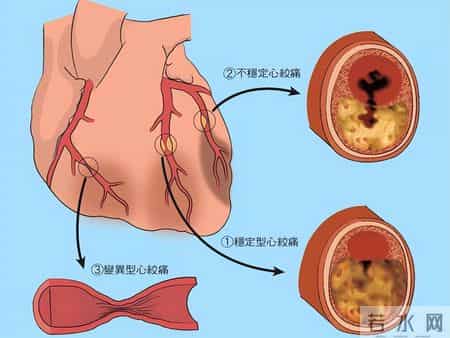 诱发冠心病加重的原因，熬夜仅排第 5，排第 1 的多数人不在意！