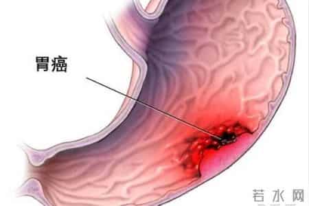 为什么很多人不愿做胃镜？医生：做一次胃镜，或能保你5年没问题