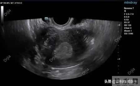 查出子宫内膜厚！调整生活方式真的有用吗？医生给你唠明白