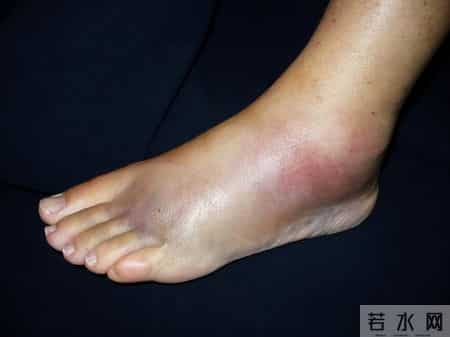 心脏出现异常时，下肢可能会有3个表现，哪怕出现一个也要重视