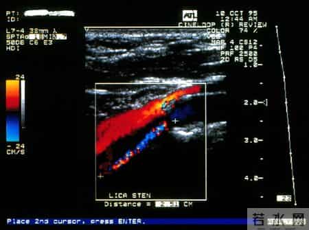 超1亿国人被查出颈动脉斑块！医生提醒：牢记这5点有望逆转斑块