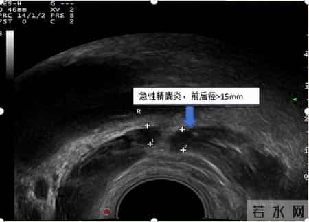 多名医生提醒：只要做过前列腺B超，中老年男性务必重视这3指标！