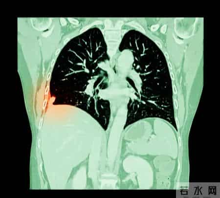 以为骨质疏松，结果是肺癌！这3种腿部表现，可能是肺在“求救”