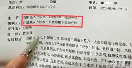 贵州一女子用502胶水贴指甲片，不慎把眼睛、鼻子粘住，当事人：清理了近1个小时，非常痛苦，有严重的濒死感