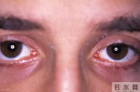 带状疱疹治疗有讲究！不同人群对应不同方案，别盲目用药