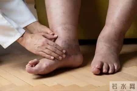 一旦腿部出现5个讯号，或说明血管已经开始堵塞，留意别不当回事