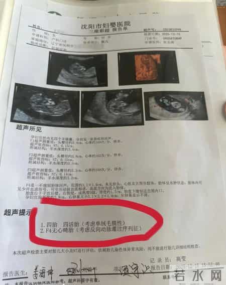 同卵四胞胎有多罕见？孕妈两个月从1胎变4胎，医生都惊叹！