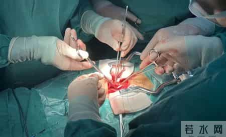 攻克难关 泌尿外科成功完成罕见重复肾移植