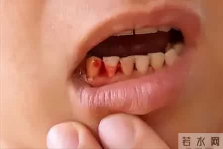 又一起吃阿司匹林丧命！转告家人：服用阿司匹林，一定注意这几事