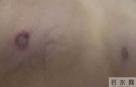 广西一夫妻遭马蜂袭击1死1伤 妻子体内八成“问题血液”被换掉