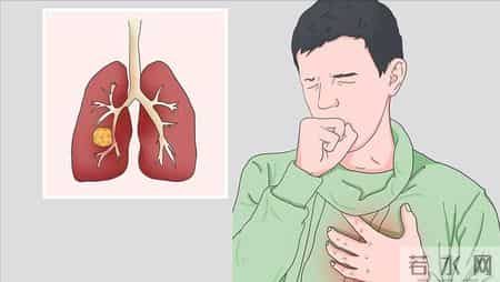 多名医生忠告：肺癌高危人群做完低剂量 CT，务必关注 4 项核心征象