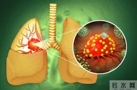 调查百名吸烟者，惊讶发现：易得肺癌的人，有这5个共性！