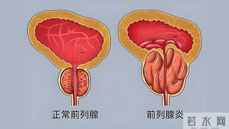 前列腺增生患者一旦活过65岁，大多出现如下症状，看看你占几个？