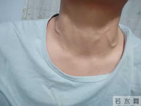 甲状腺癌手术很成功，病人却活不长？医生：很多人忽视术后这几事