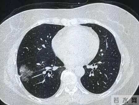 56岁男子3月体检肺结节，年底查出肺癌晚期，医生：5类人要注意