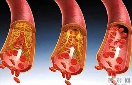 哈工大研究：低密度胆固醇越低，癌症风险越高？控制到多少才好