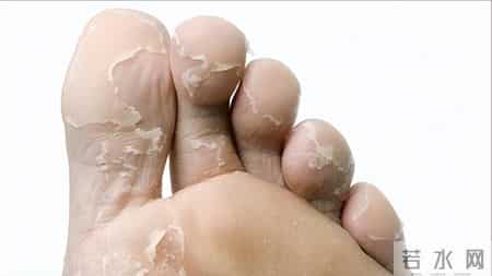 脚气总是反反复复？医生提醒：若发现脚气，日常谨记“3做4不做”