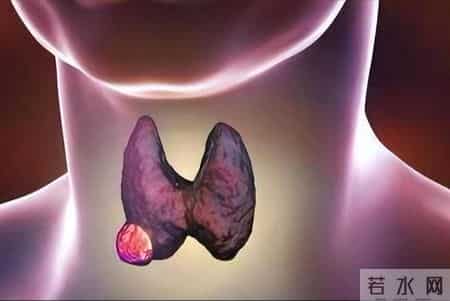 医生发现：甲状腺癌患者若每天睡午觉，不出半年，或出现4个变化