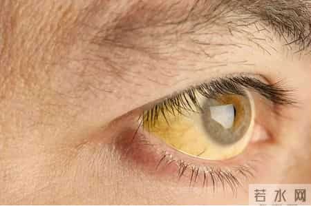 46岁男子皮肤瘙痒以为是海鲜过敏，检查结果出来傻眼了：肝癌晚期