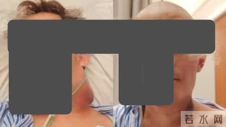 多学科协作，上海九院助33岁极晚期舌癌患者闯过生死关