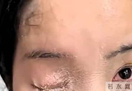 惊人意外！女子贴指甲片不慎打翻502胶水，眼睛、鼻孔全粘住！