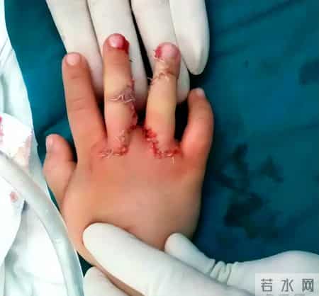 疼死了！新生儿被剪断手指紧急转院，暂不谈赔偿，家属发声太揪心