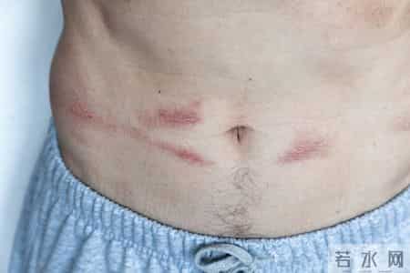 专家分析500名梅毒患者，发现感染梅毒的人，有5大特点