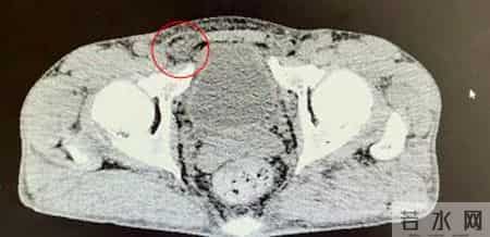 常跑10公里，55岁男子腹股沟突现“核桃”包块！普外科医生提醒：腹壁薄弱+长期腹压增高或是元凶