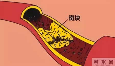 体检发现这8个信号！可能是冠心病加重前兆，别拖延及时就医评估