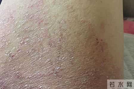 湿疹拖太久可能暗藏隐患，医生提醒：皮肤若出现这5种异常要警惕