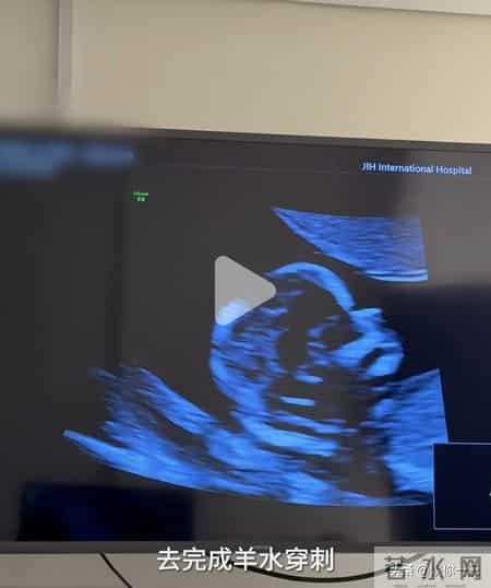 程晓玥透露二胎因吃药导致NT异常！羊水穿刺伤口令人心疼