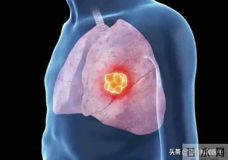 重磅突破！新疗法Olvi-Vec双线告捷，晚期肺癌疾病控制率超60%