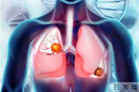 医生发现：肺癌患者若常喝金银花茶，不用多长时间，或有5大好处