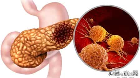 男子频繁腹泻，多次检查肠镜正常，直到换了检查项目：是癌王