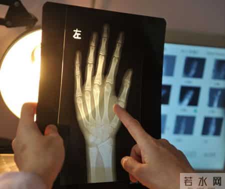 测骨龄的最佳时期只有12年，尤其是这6类孩子，家长需要高密监测