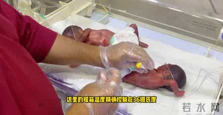 出生0.6公斤的双胞胎婴儿，50天后的样子，简直不敢认