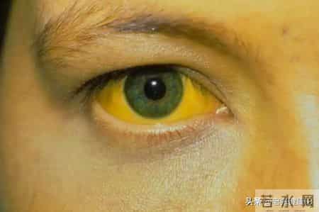 男子频繁腹泻，多次检查肠镜正常，直到换了检查项目：是癌王