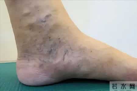 斑块和洗脚有关系？医生建议血管不好的人，洗脚时多留心这5点